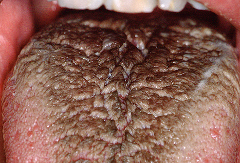 hairy tongue