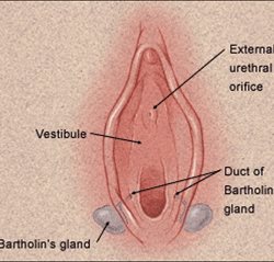 Bartholin Gland cyst or abscess, i.e. The Newlyweds or Honeymoon Disease
