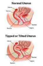 Define This: Retroverted Uterus